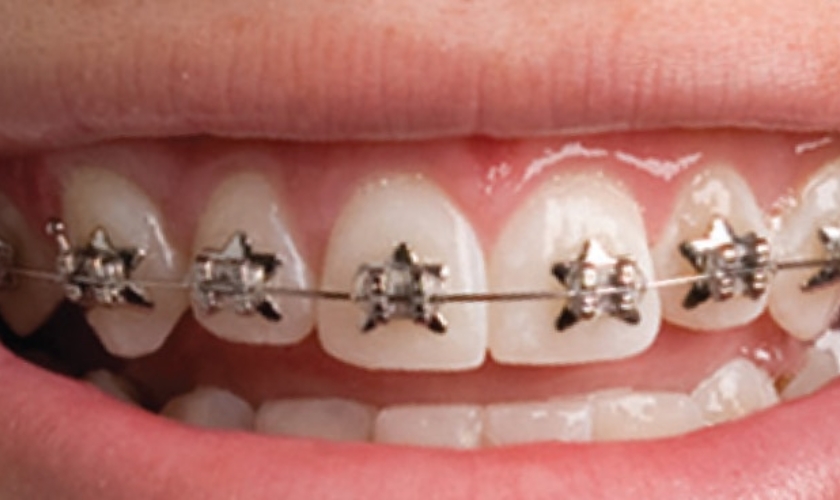Find the Best Orthodontist for Braces in Charlotte, NC