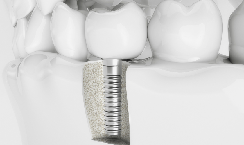 Myths and Facts About Dental Implants: What You Should Know