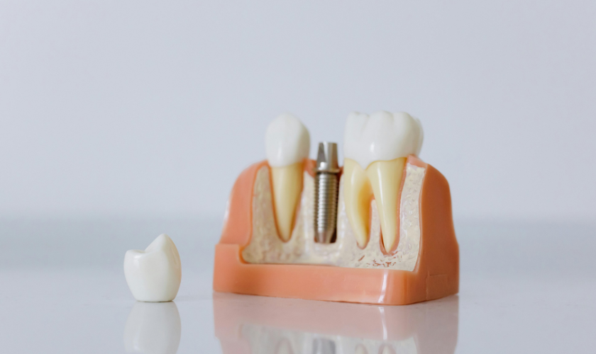 Dental Implants for Missing Teeth